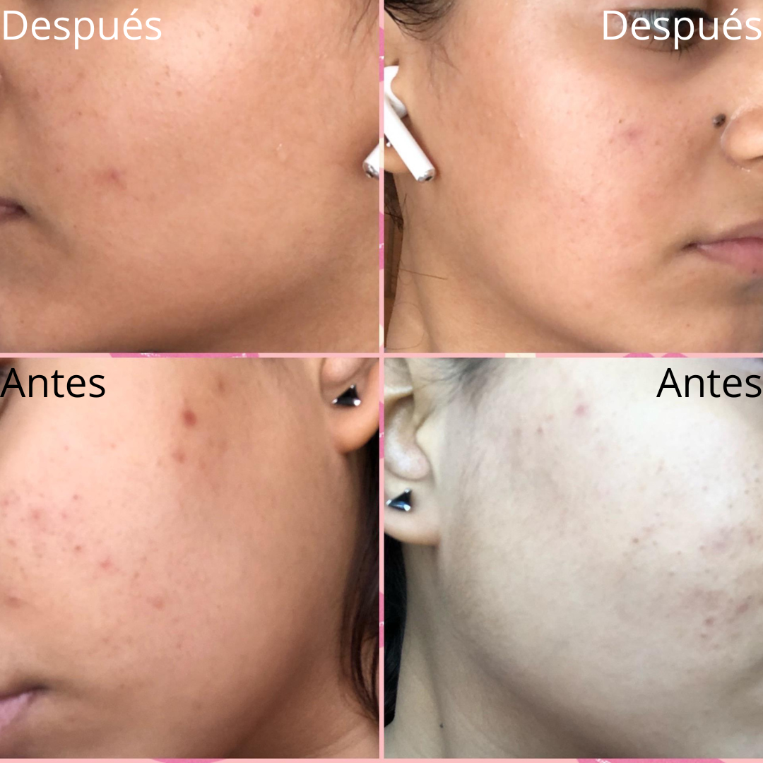 COMBO ACLARANTE + ANTIACNE + SLIM GEL - ✨ Tu rutina completa en un solo combo (fácil y práctico)”
