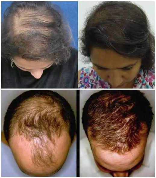 BodyWise Hair Growth-¡Devuélvele Vida a Tu Cabello! Más fuerza, más volumen y una apariencia saludable desde la raíz.